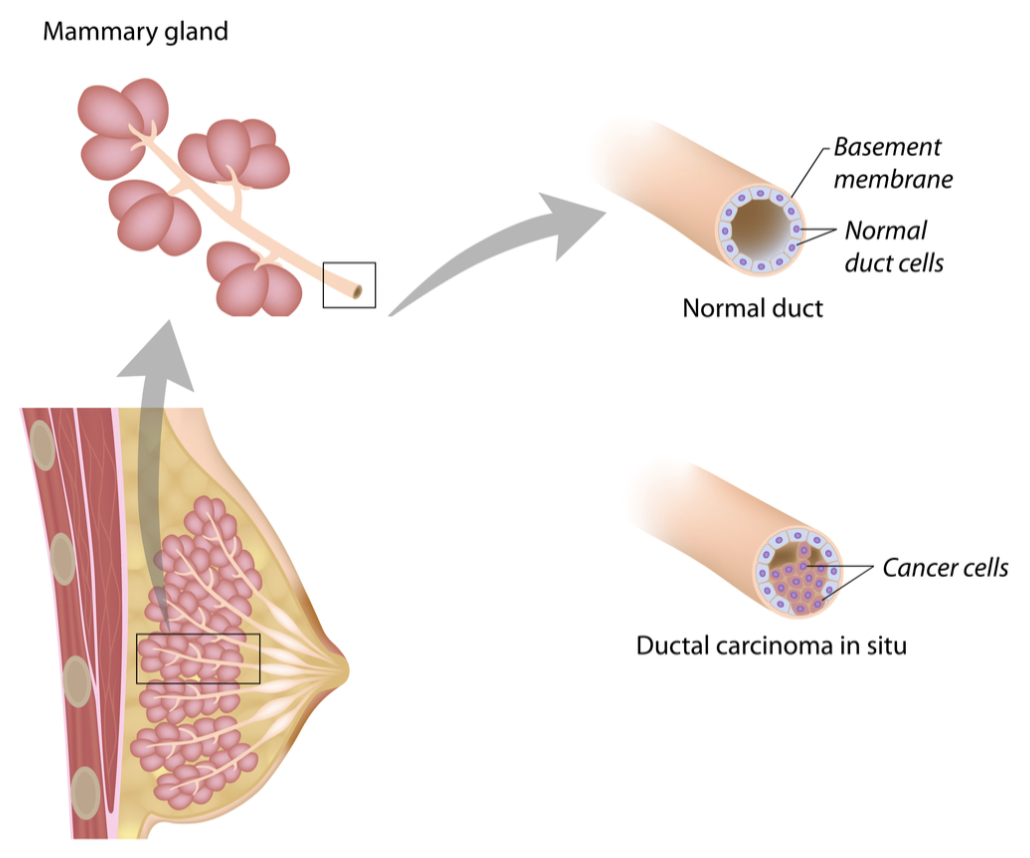 About Breast Cancer - Roche